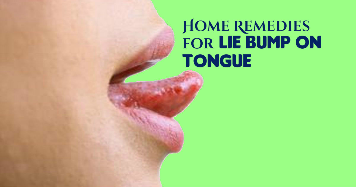 Tongue Bumps: Enlarged Papillae and Other Problems
