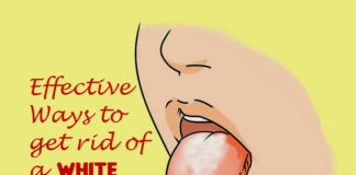 Quick Ways to Get Rid of White Tongue