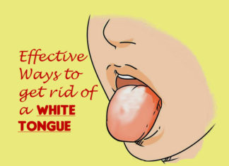 Quick Ways to Get Rid of White Tongue