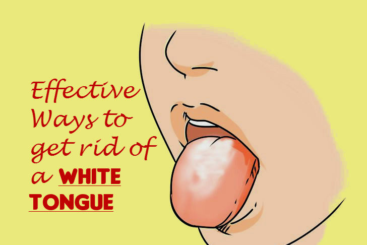 Quick Ways to Get Rid of White Tongue