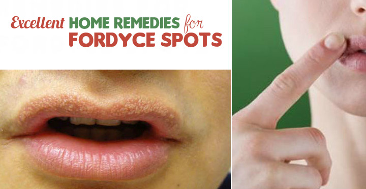 Excellent Home Remedies for Fordyce Spots
