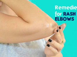 how to get rid of Rash on Elbows