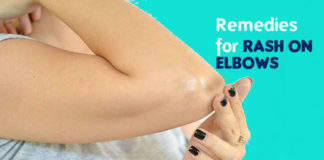 how to get rid of Rash on Elbows