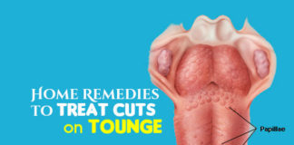 Heal Cuts on Tongue Using Simple Home Remedies