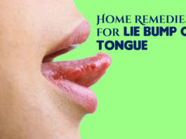 Lie Bumps on Tongue Natural Treatment