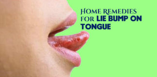 Lie Bumps on Tongue Natural Treatment