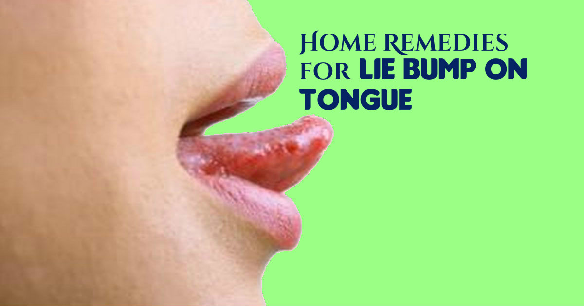 Is There A Such Thing As A Lie Bump On Your Tongue