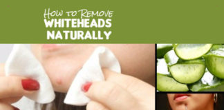 Remove Whiteheads