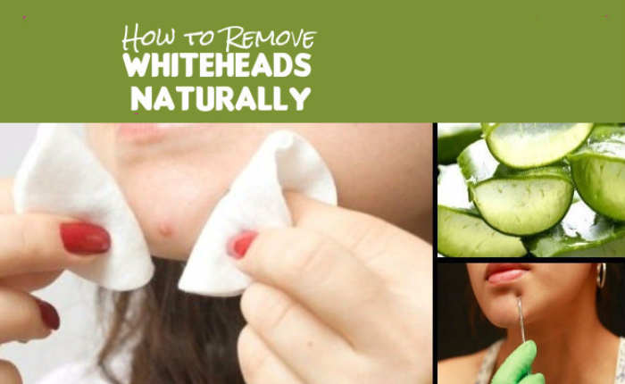 Excellent Ways To Remove Whiteheads Naturally At Home