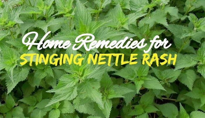 What Soothes Stinging Nettle Rash