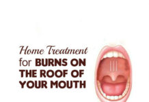 home-remedies-for-burns-on-the-roof-of-your-mouth