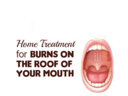 home-remedies-for-burns-on-the-roof-of-your-mouth