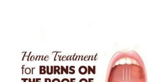 home-remedies-for-burns-on-the-roof-of-your-mouth