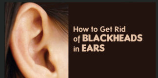 How to Get Rid of Blackheads in Ear