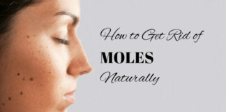 Home remedies to get rid of moles naturally