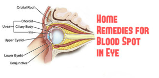 Natural Home Remedies for Blood Spot in Eye