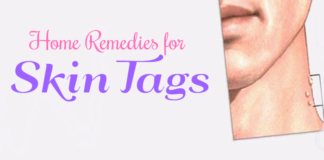 Simple and effective Home Remedies for Skin Tags