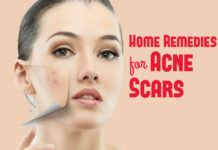 how to get rid of acne scars using home remedies