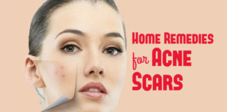 how to get rid of acne scars using home remedies