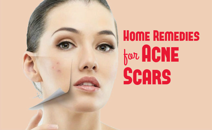 how to get rid of acne scars using home remedies