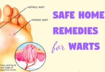 Safe home remedies for warts naturally at home