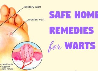 Safe home remedies for warts naturally at home