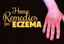 how to get rid of eczema naturally at home