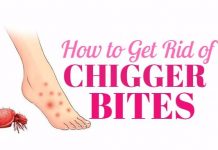 home remedies to get rid of chigger bites
