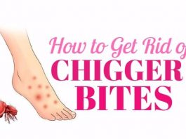 home remedies to get rid of chigger bites