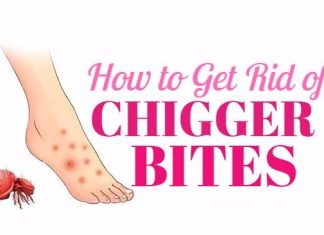 home remedies to get rid of chigger bites