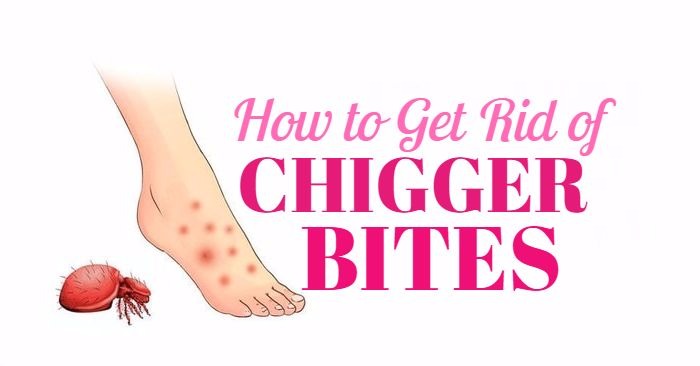 How to Treat Chigger Bites Naturally using Home Remedies