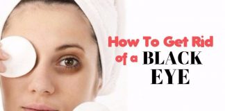 home remedies to get rid of black eye