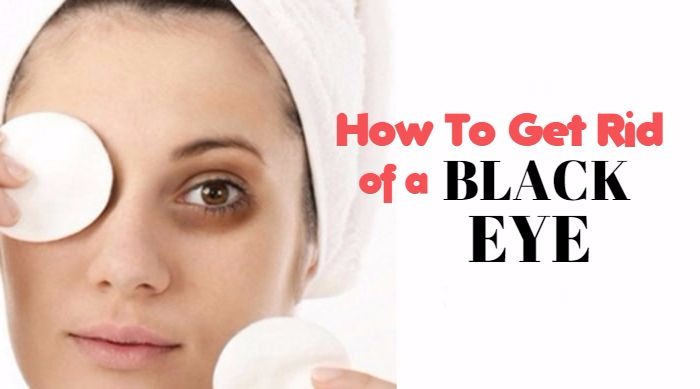 how-get-rid-of-black-eye-naturally-with-home-remedies