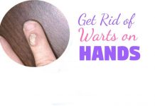 Home Remedies to Get Rid of Warts on Hands and Fingers
