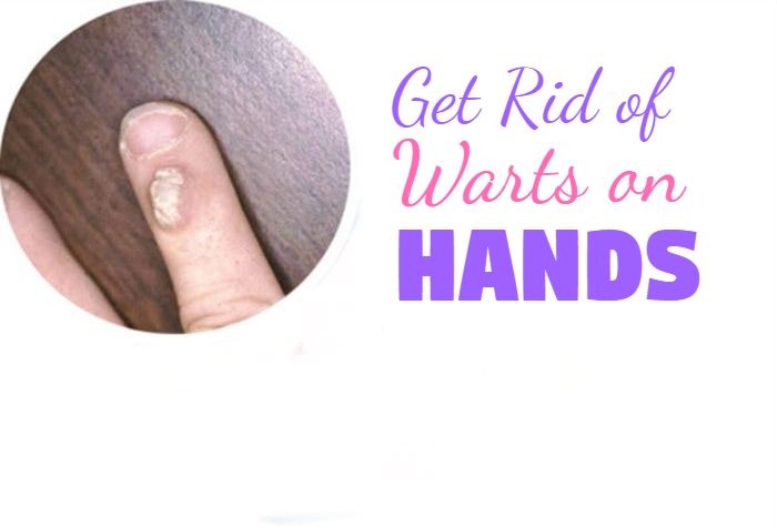 How Get Rid of Warts on Hands and Fingers Naturally