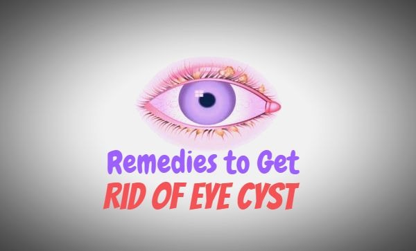 Perfect Remedies to Get Away With an Eye Cyst