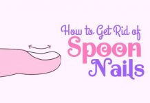 How to Get Rid of koilonychias/Spoon Nails with Home Remedies