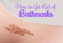 How to Get Rid of Birthmarks Naturally