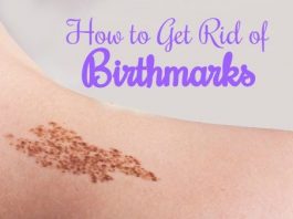 How to Get Rid of Birthmarks Naturally