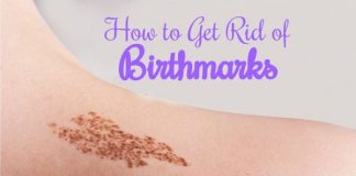 How to Get Rid of Birthmarks Naturally