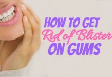 Get Rid of Blister on Gums