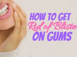 Get Rid of Blister on Gums