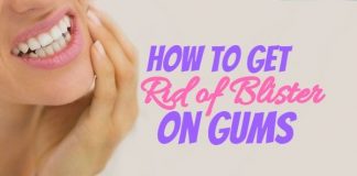 Get Rid of Blister on Gums