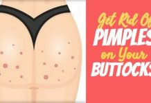 Effective Home Remedies To Get Rid Of Pimples on Your Buttocks