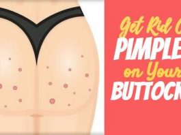 Effective Home Remedies To Get Rid Of Pimples on Your Buttocks