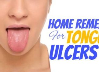 Remedies To Ease Your Tongue Ulcers