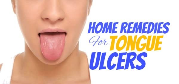 18-dexterous-home-remedies-to-ease-your-tongue-ulcers