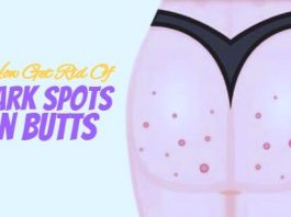 How To Get Rid Of Dark Spots On Butt