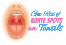 How to Get Rid of White Spots on Tonsils at home