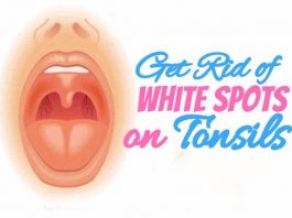 How to Get Rid of White Spots on Tonsils at home
